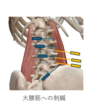 大腰筋刺鍼２