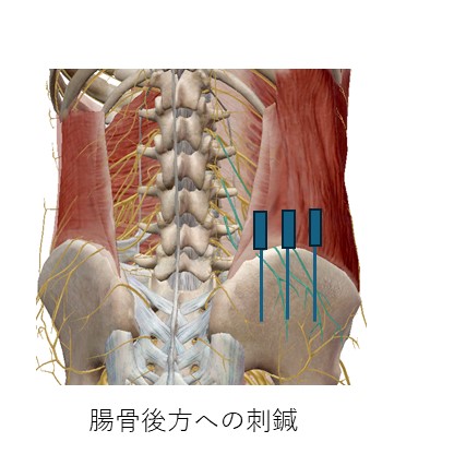 腸骨後方への刺鍼